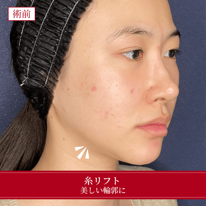 施術前